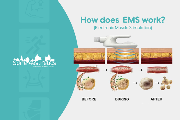 EMS treatment for post pregnancy weight loss treatment Barry