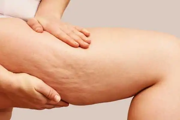 Image of woman showing leg with cellulite Barry