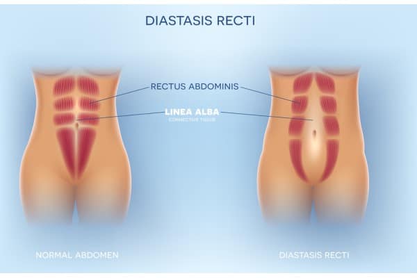 What Non-Surgical Options Are Available for Diastasis Recti Barry?