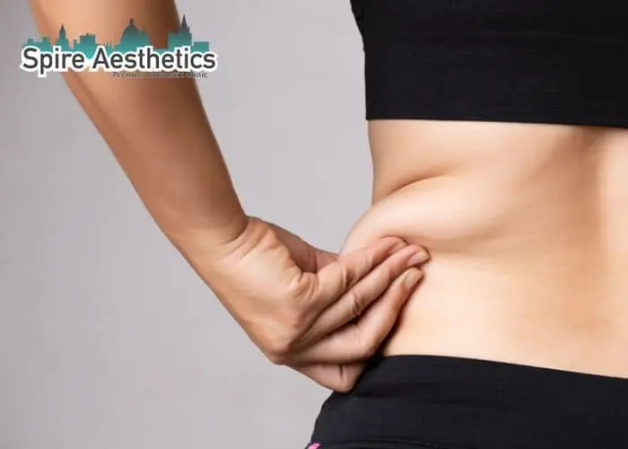 Image of woman pinching fat on their hips Barry. Fat Freezing treatment