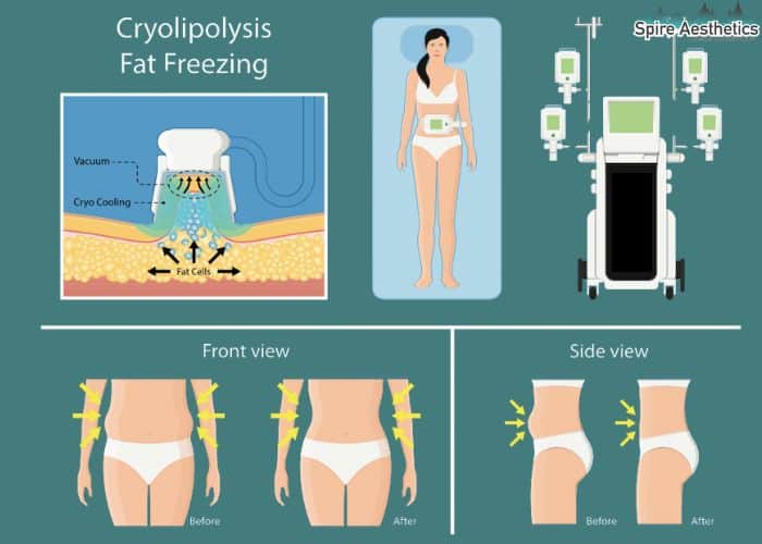 Image of diet and fat freezing combined for best results for Spire Aesthetics Barry