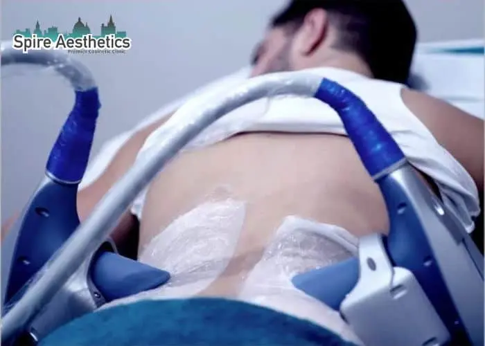 Man having fat freezing treatment done on love handles before a competitions Barry to create a sculpted look.