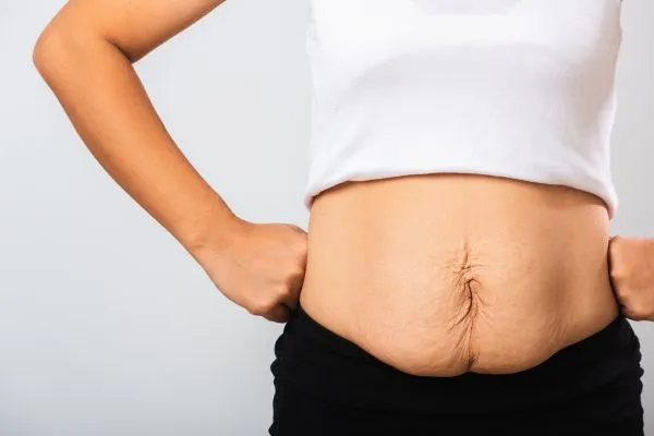 Image of a woman's stomach after weight loss with sagging skin following a gastric band Barry