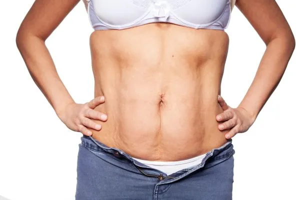 sagging skin on woman's stomach after weight loss injections Barry