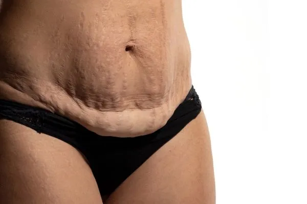Image of womans stomach after weight loss injections Barry showing saggy skin