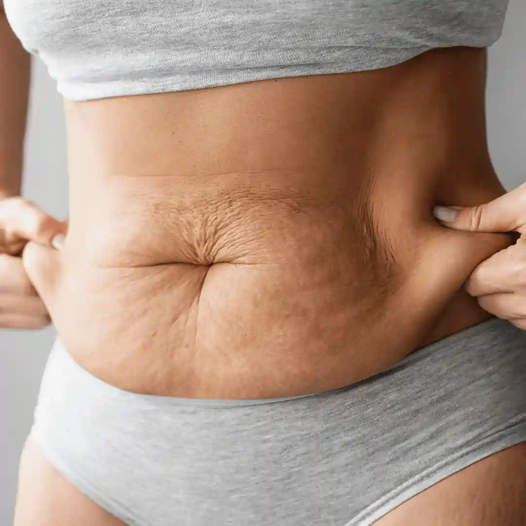 Is It Normal to Have Loose Skin After Pregnancy Barry?