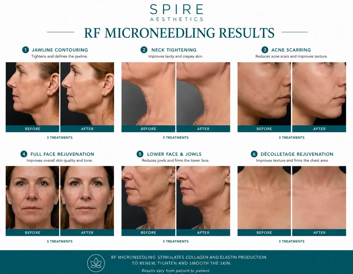 RF Microneedling Skin tightening Barry results