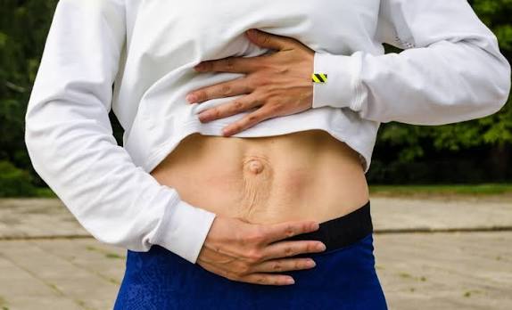 When Could Diastasis Recti Be the Missing Piece of the Puzzle Barry?