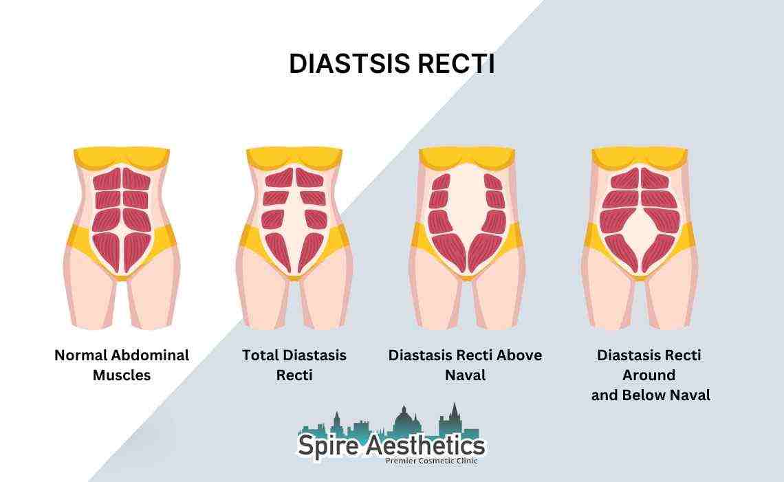 Is Non-Surgical Diastasis Recti Treatment Right for You? Common Concerns Answered Barry